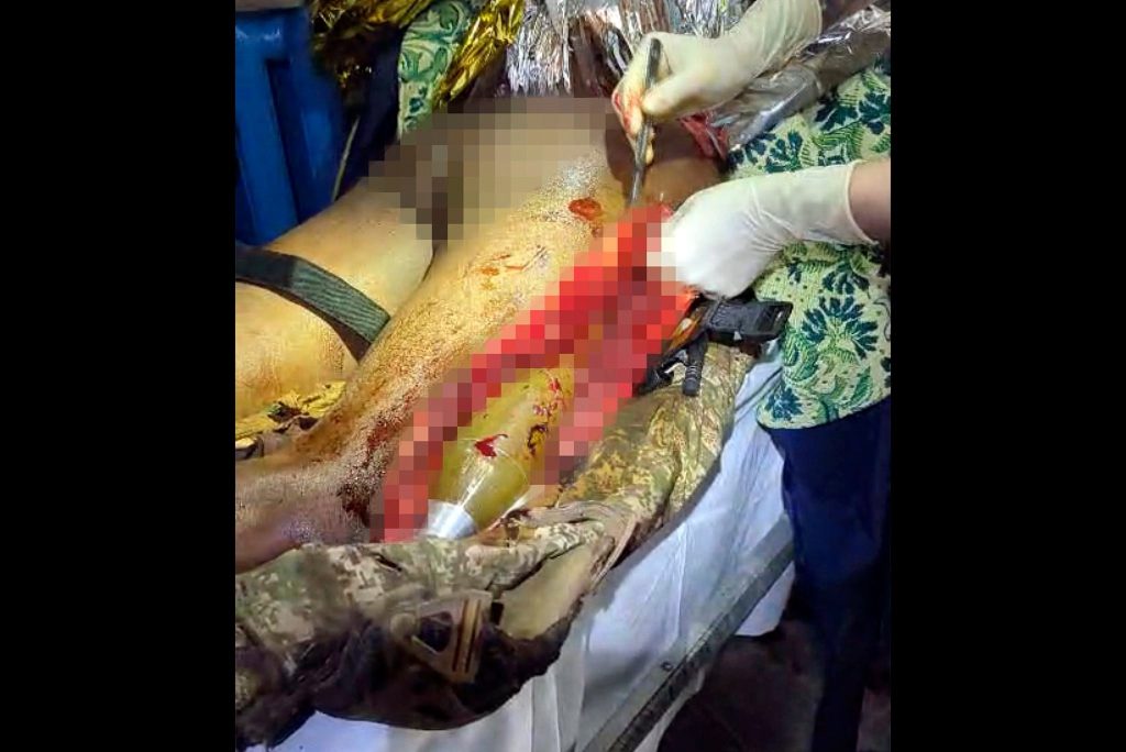 Снаряд, витягнутий із ноги